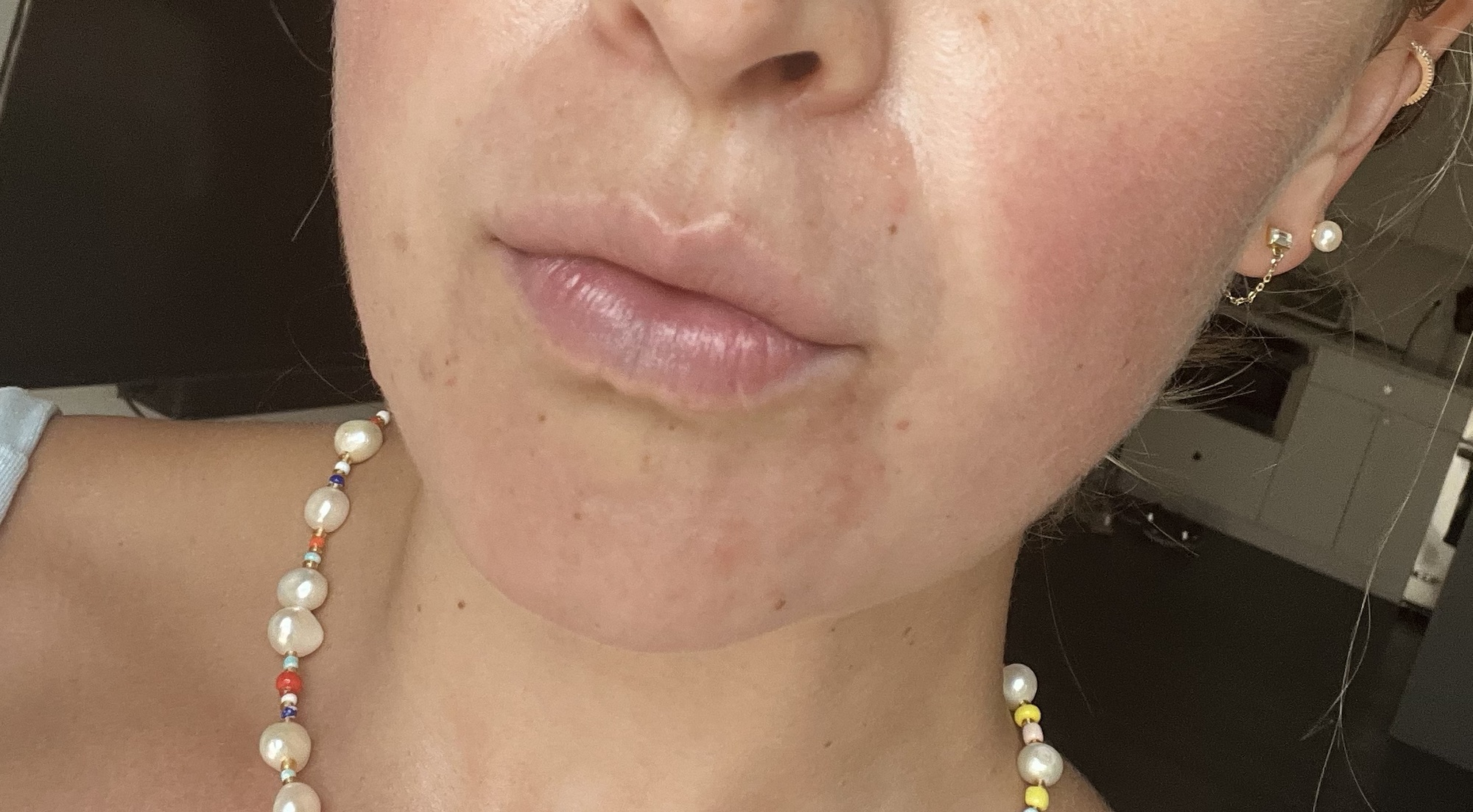 Update: How I’m Addressing My Skin Rash